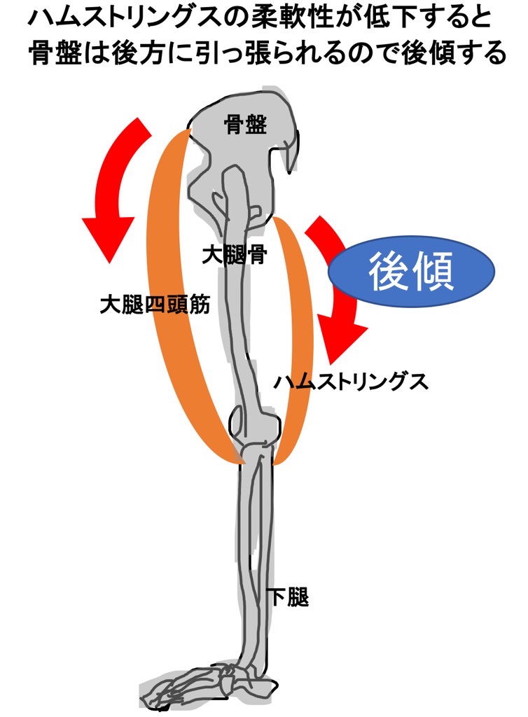 骨盤の後傾とハムストリングス