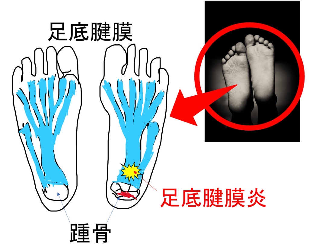 足底腱膜炎