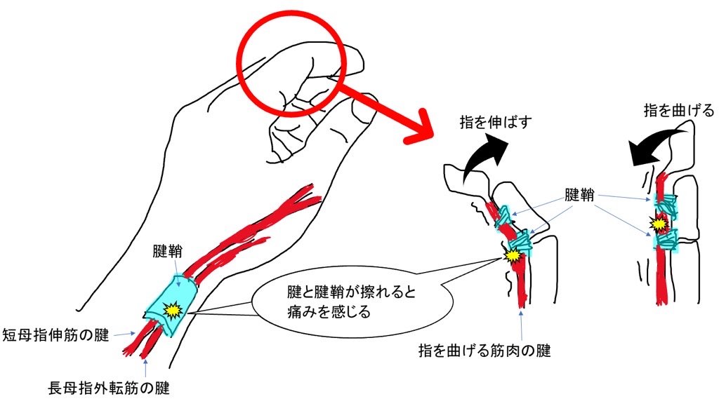 腱鞘炎