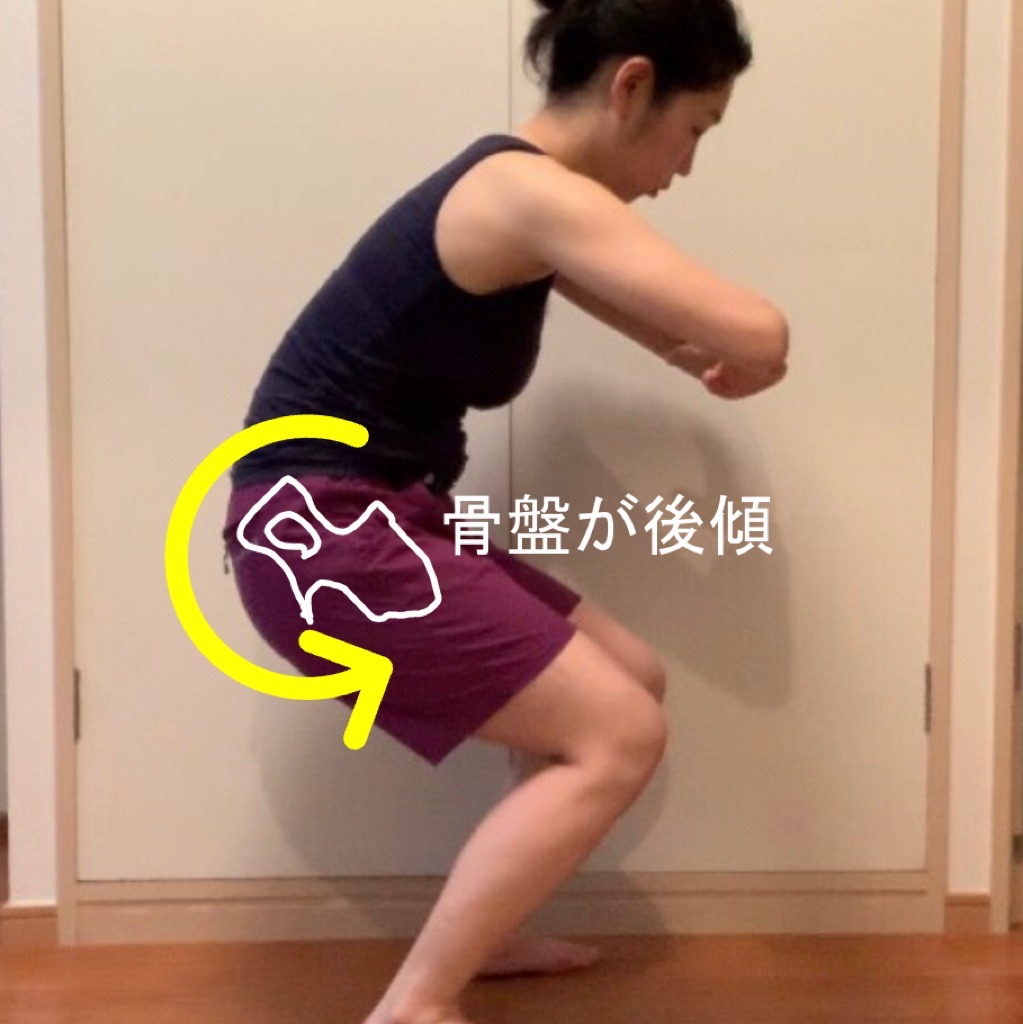 骨盤の後傾