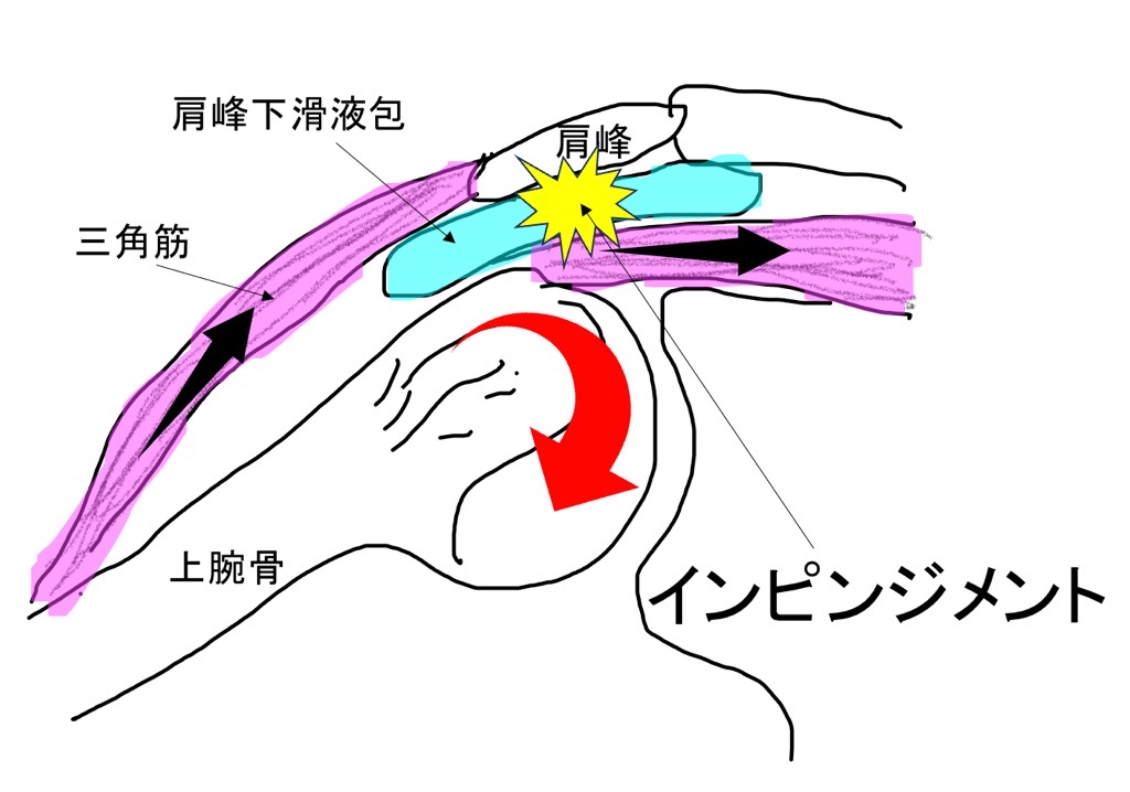 インピンジメント症候群